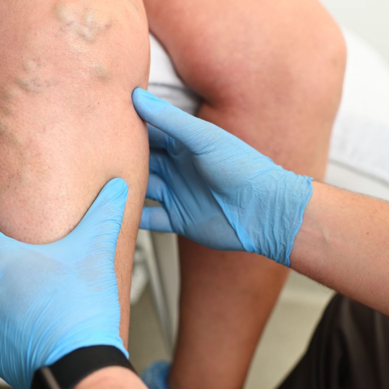 Exame médico avaliando sinais de trombose e varizes na perna