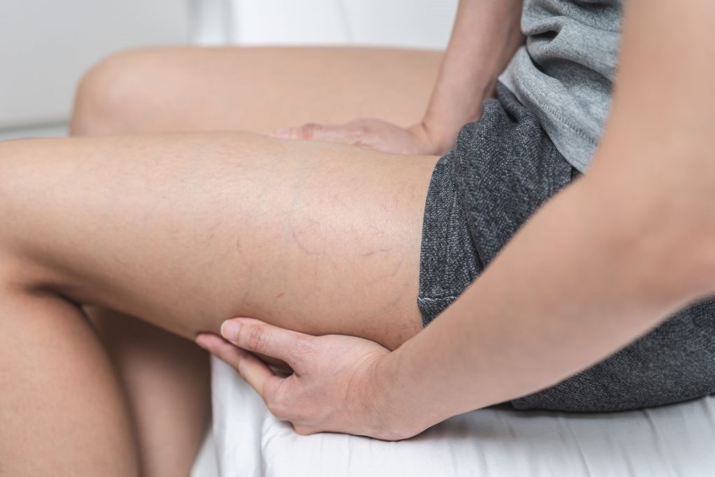 Mulher segurando a perna com sinais de inchaço associados à trombose